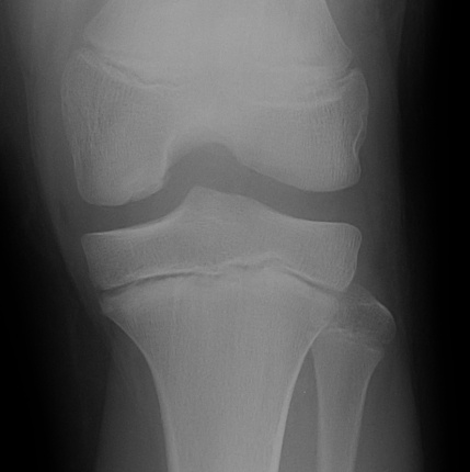 Knee OCD Xray Type 3